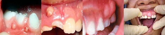 Tooth Decay